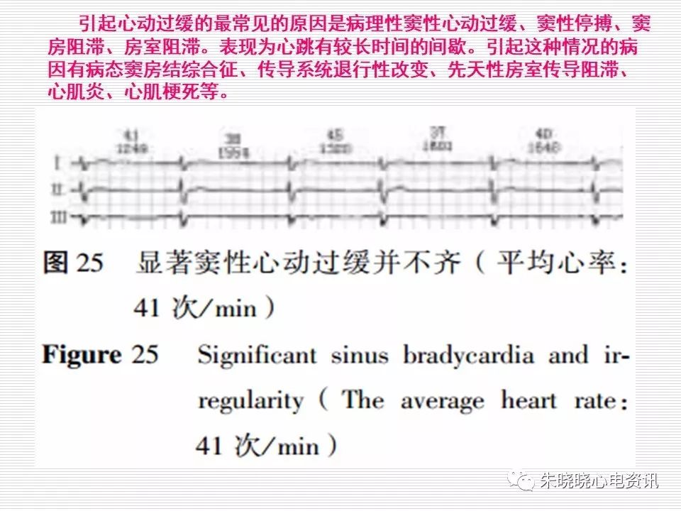 心电图危急值识别与诊断，看完我就收藏了！