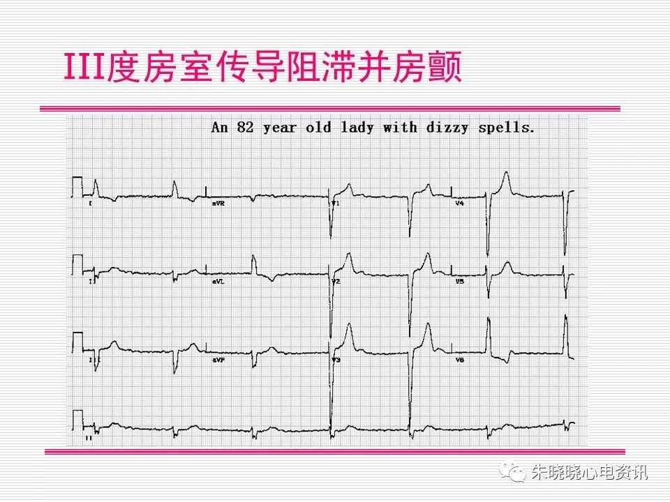 心电图危急值识别与诊断，看完我就收藏了！