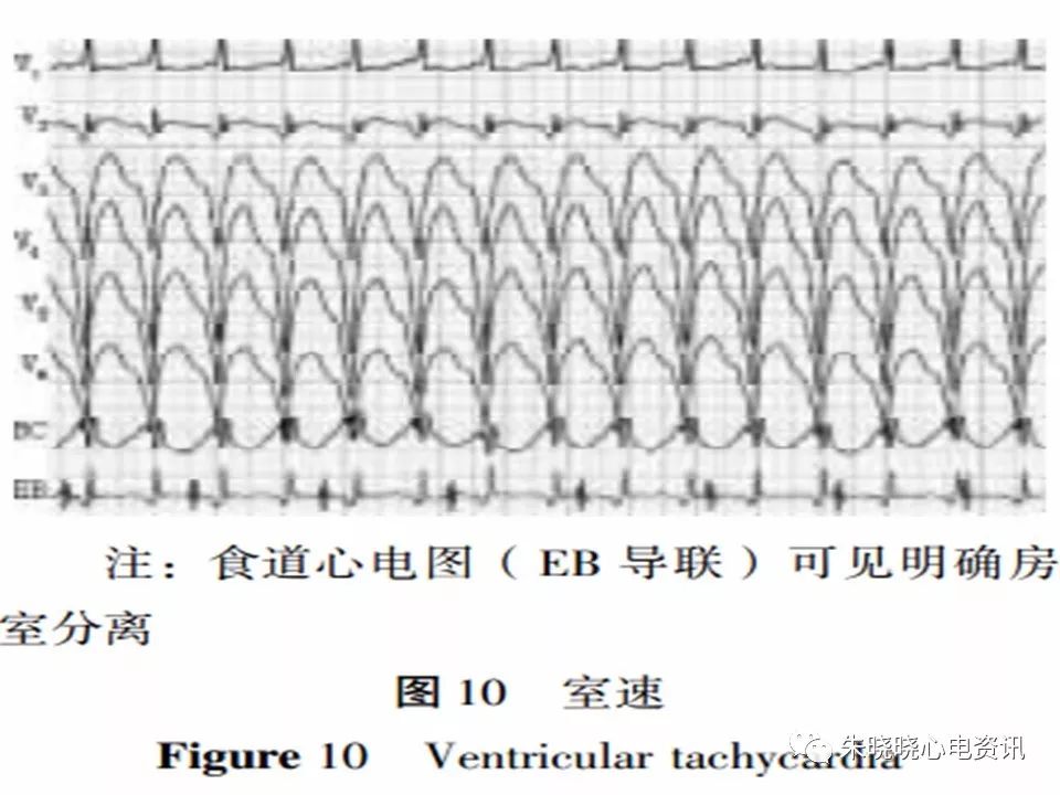心电图危急值识别与诊断，看完我就收藏了！