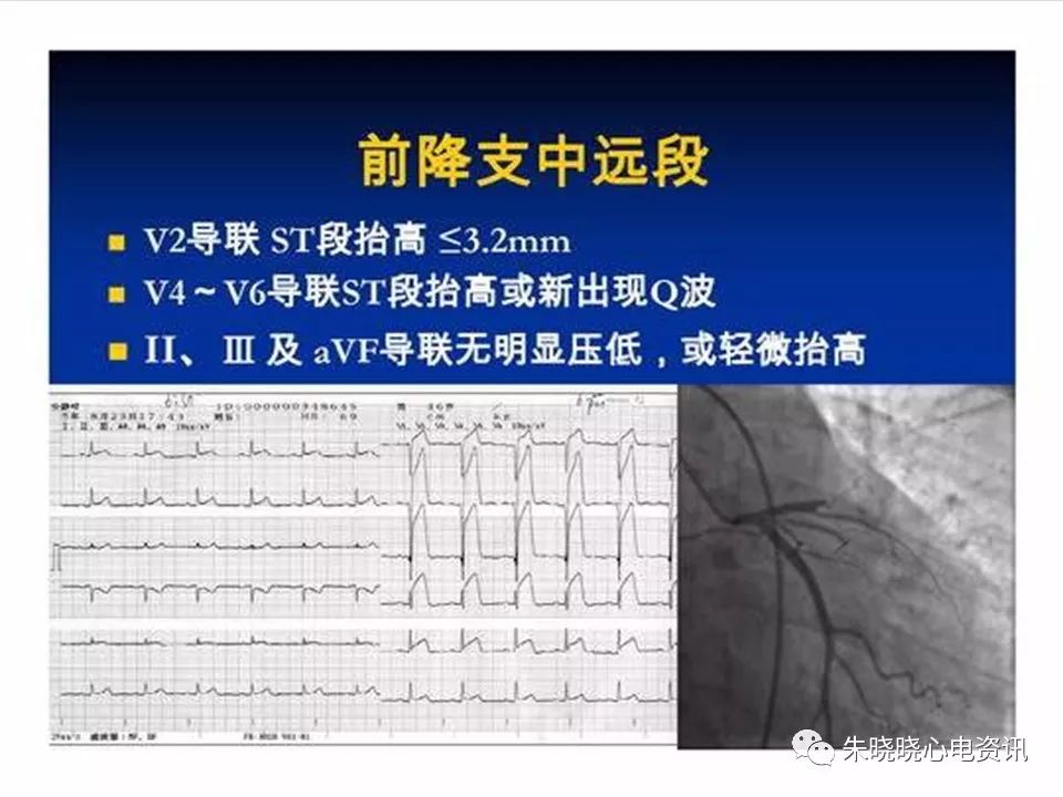 心电图危急值识别与诊断，看完我就收藏了！