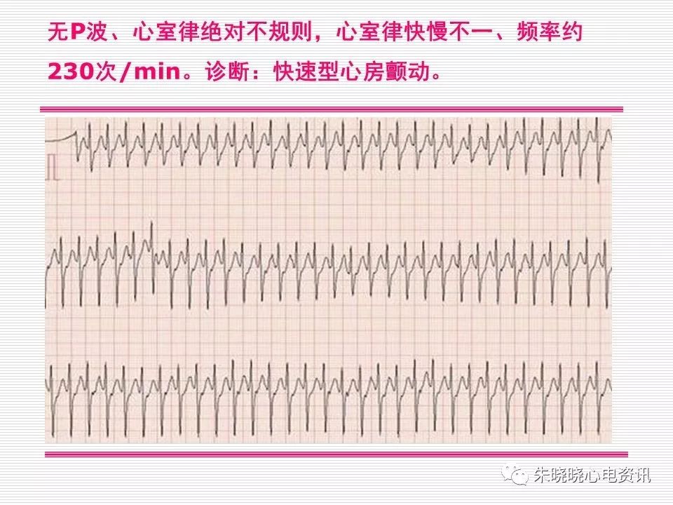 心电图危急值识别与诊断，看完我就收藏了！