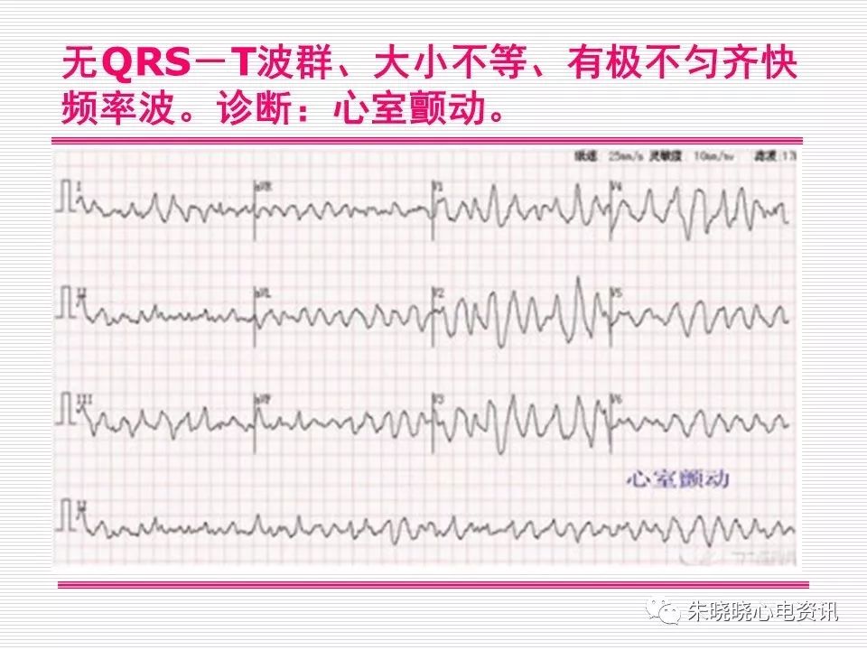 心电图危急值识别与诊断，看完我就收藏了！