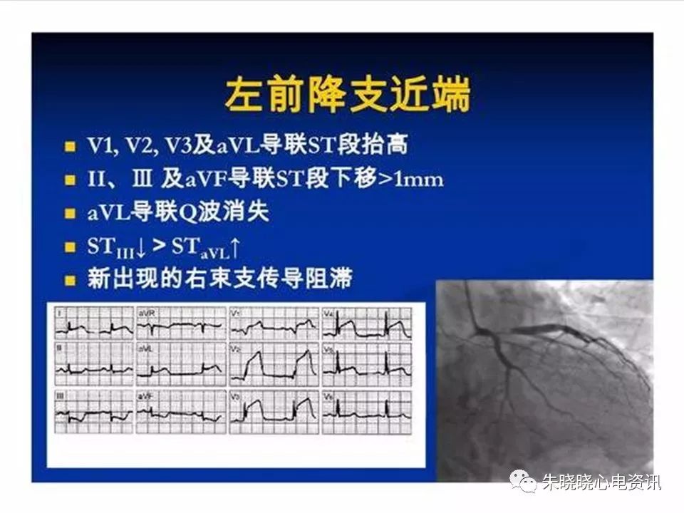 心电图危急值识别与诊断，看完我就收藏了！