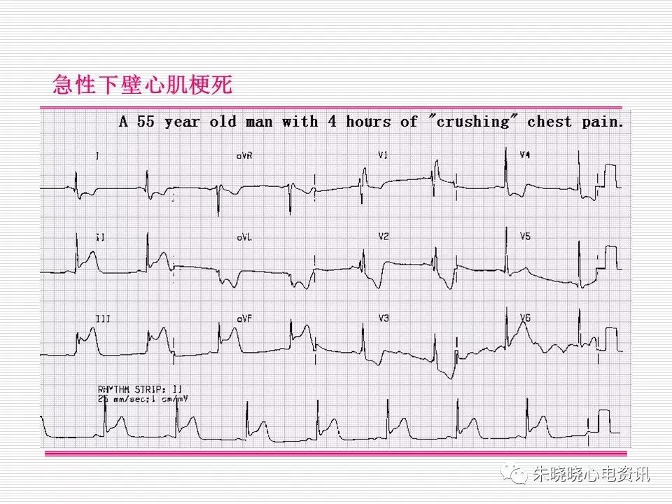 心电图危急值识别与诊断，看完我就收藏了！