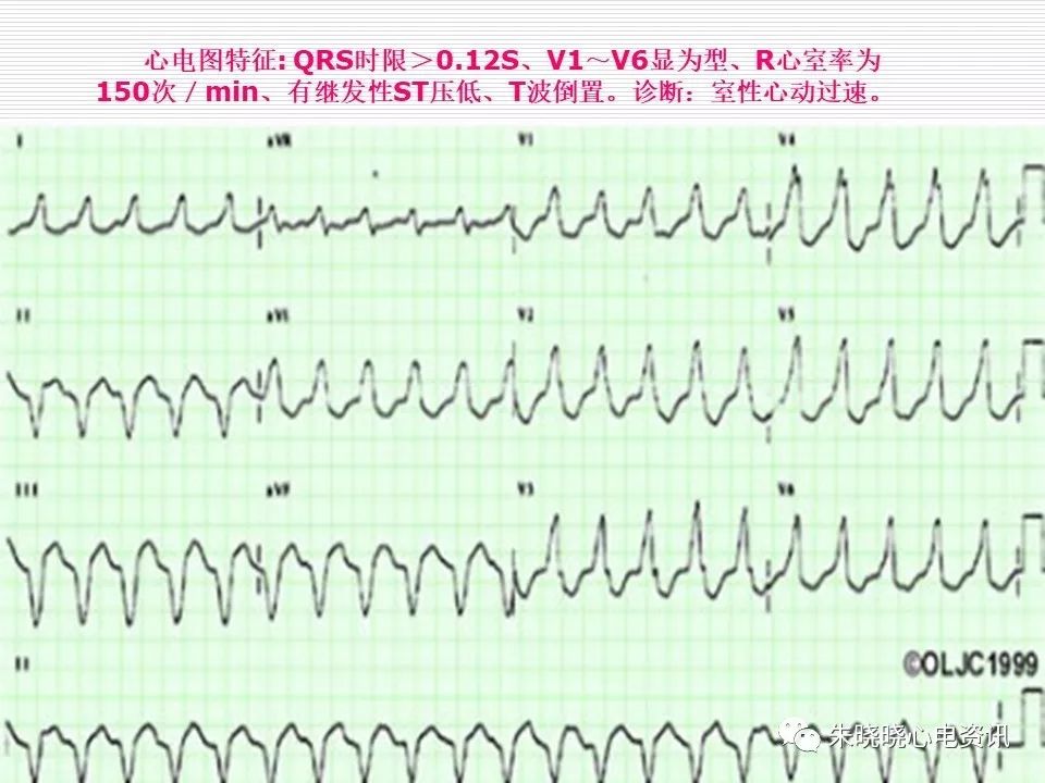 心电图危急值识别与诊断，看完我就收藏了！