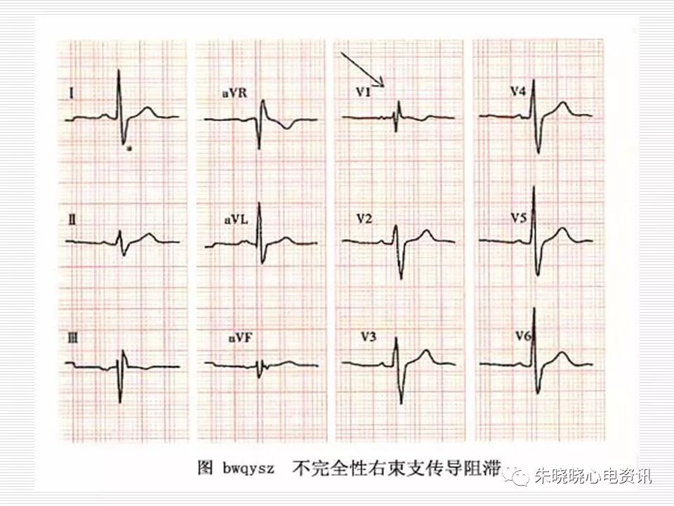 心电图危急值识别与诊断，看完我就收藏了！