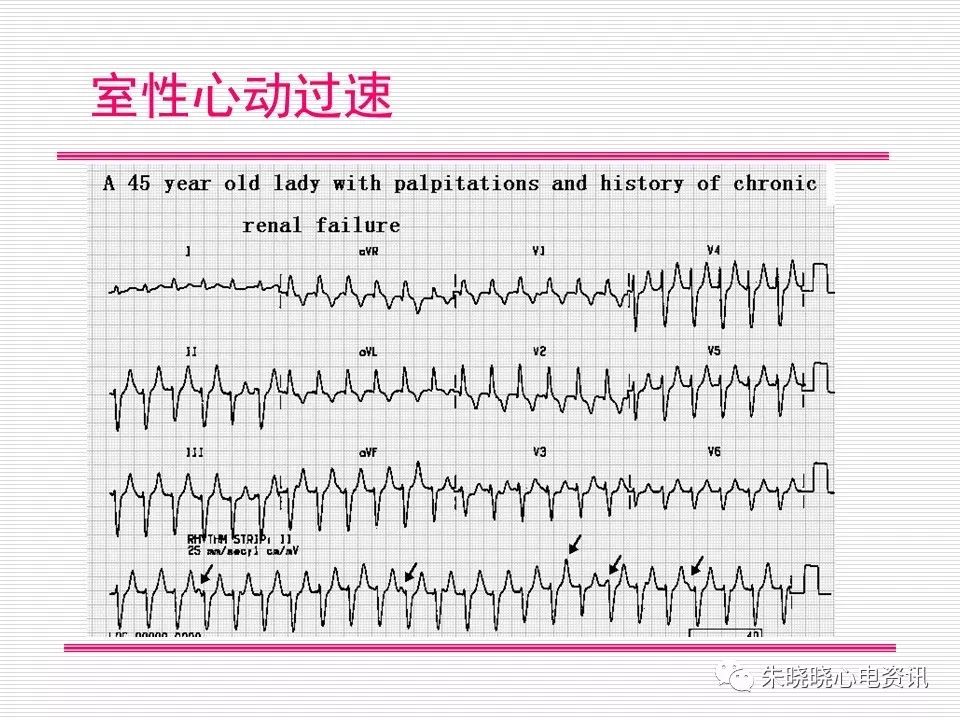 心电图危急值识别与诊断，看完我就收藏了！