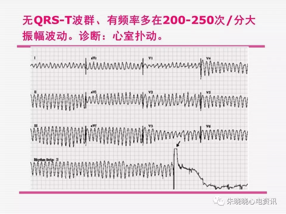 心电图危急值识别与诊断，看完我就收藏了！
