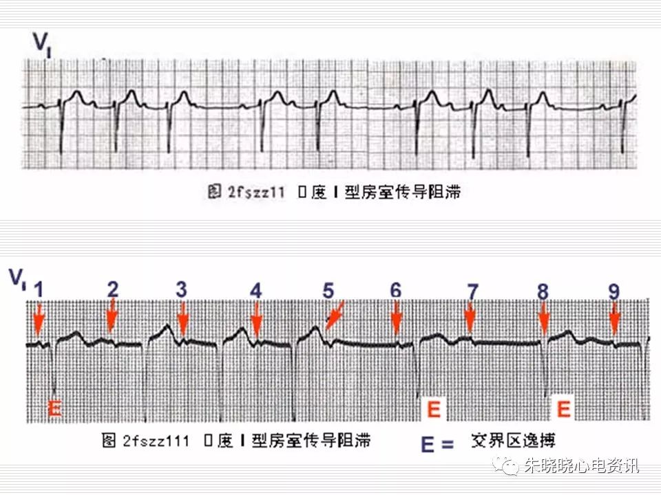 心电图危急值识别与诊断，看完我就收藏了！