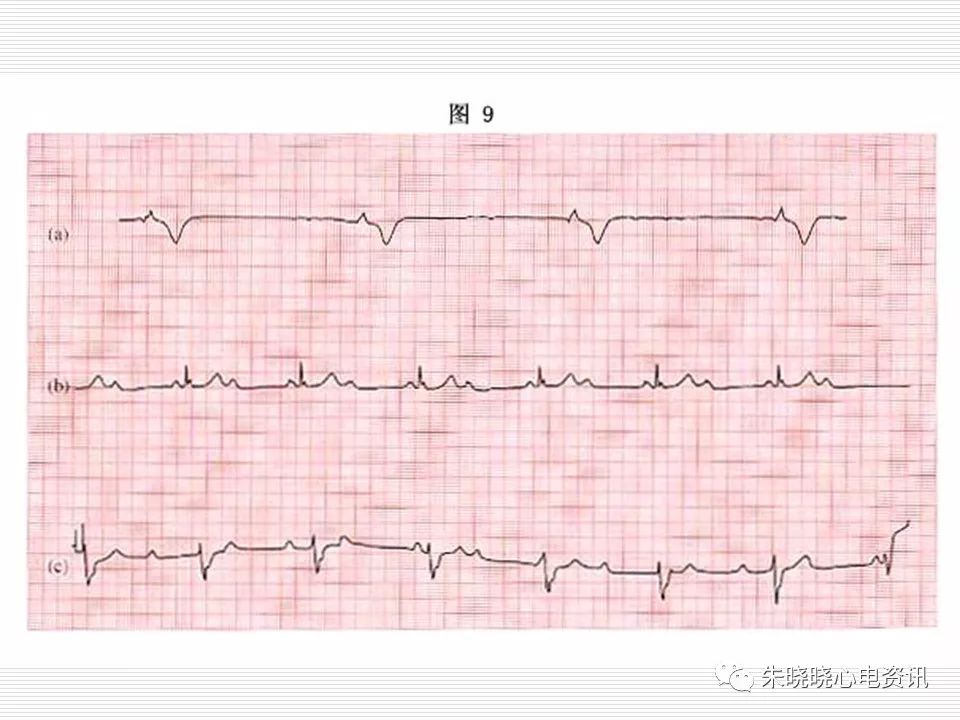 心电图危急值识别与诊断，看完我就收藏了！