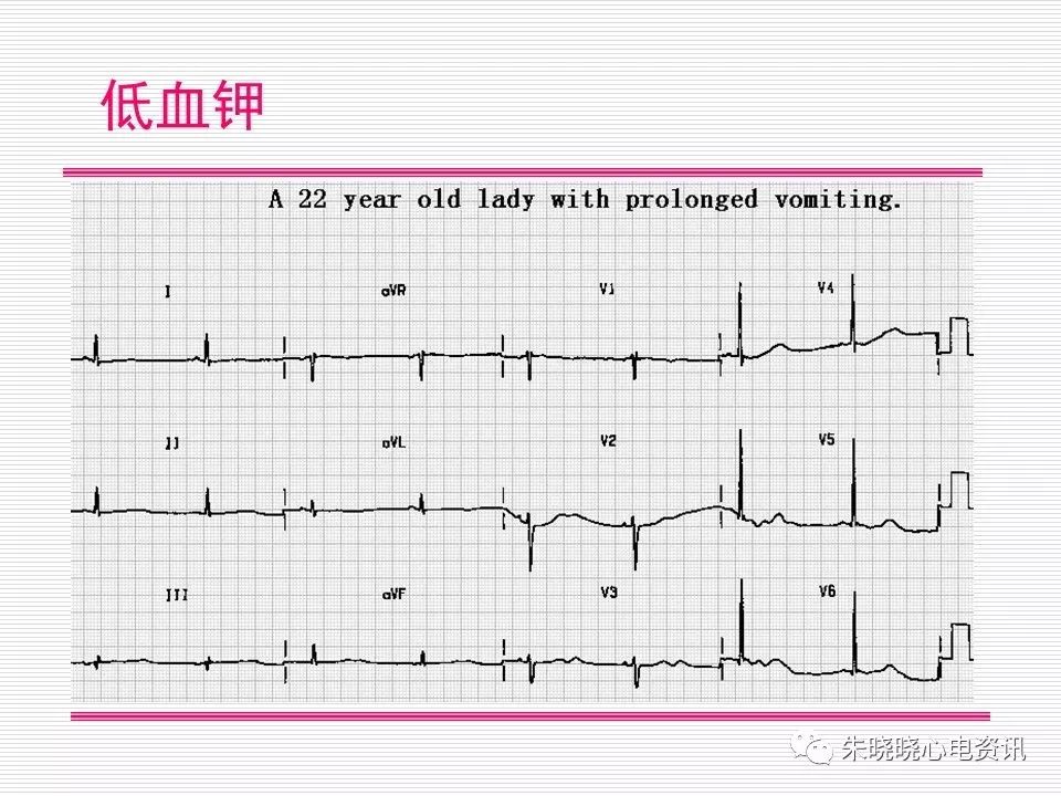 心电图危急值识别与诊断，看完我就收藏了！