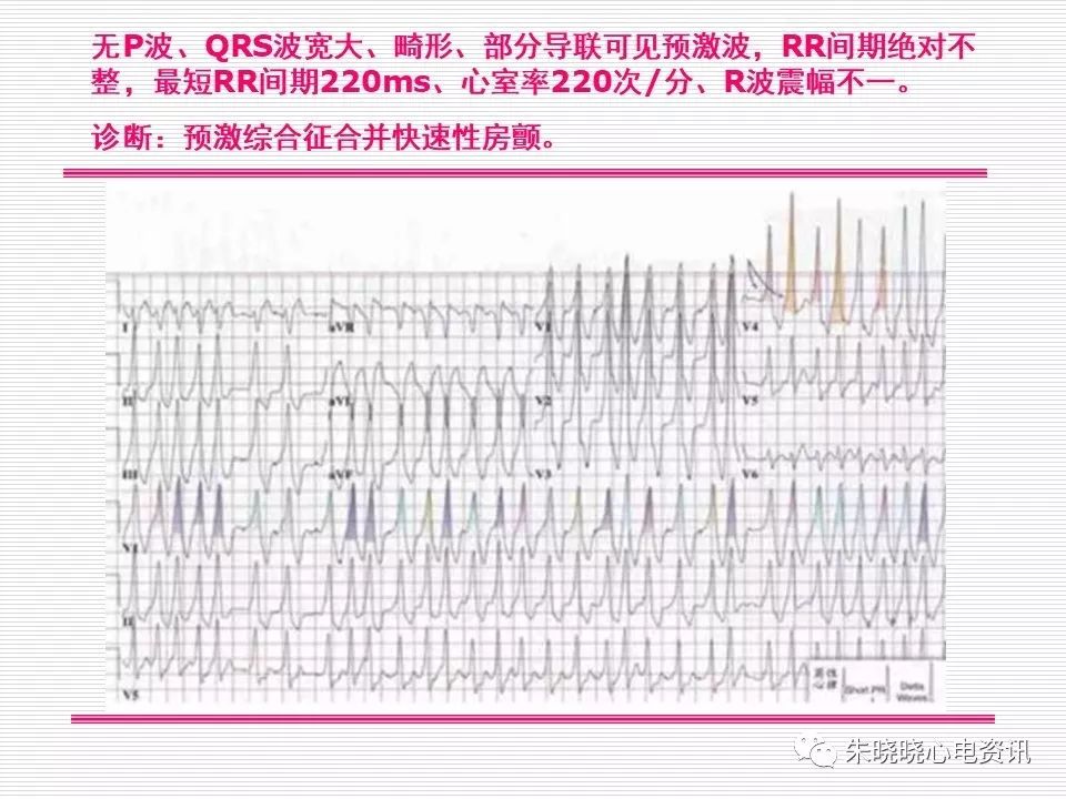 心电图危急值识别与诊断，看完我就收藏了！