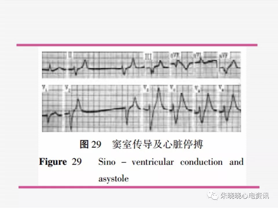 心电图危急值识别与诊断，看完我就收藏了！