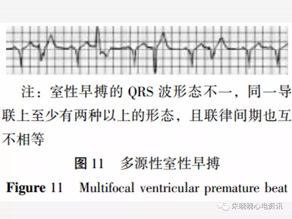 心电图危急值识别与诊断，看完我就收藏了！