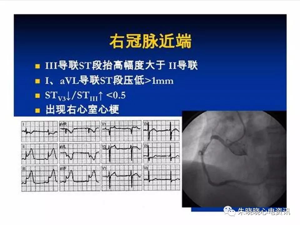 心电图危急值识别与诊断，看完我就收藏了！