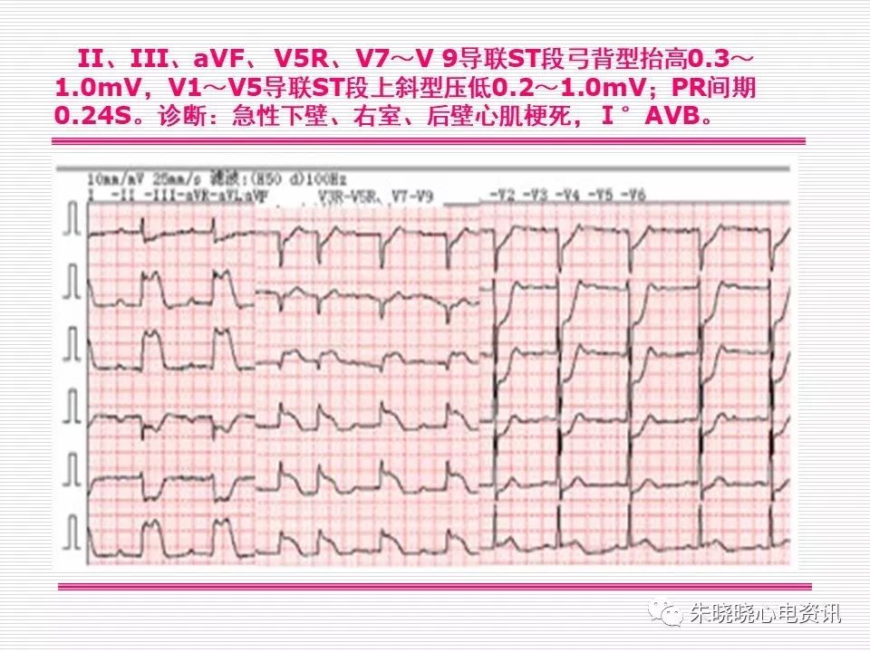 心电图危急值识别与诊断，看完我就收藏了！