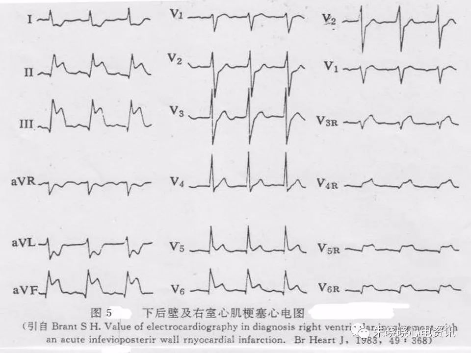 心电图危急值识别与诊断，看完我就收藏了！