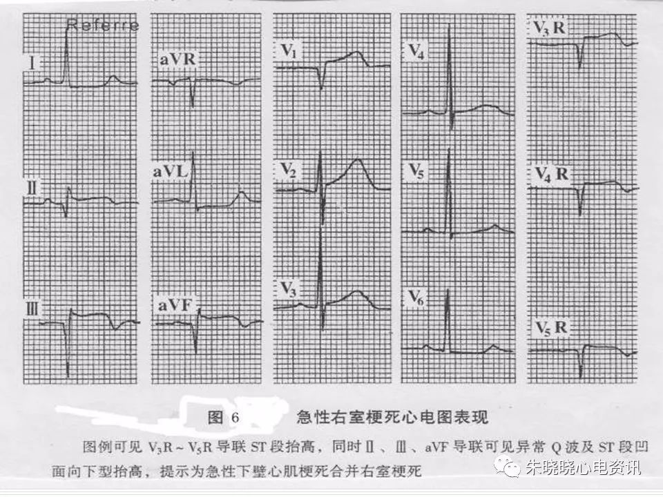 心电图危急值识别与诊断，看完我就收藏了！