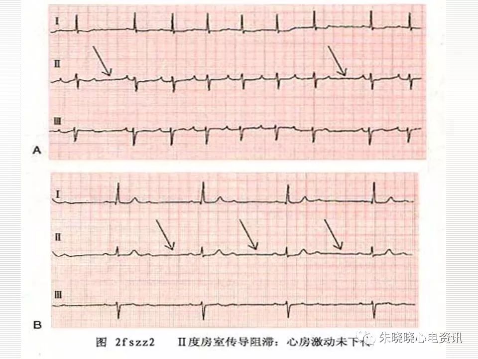 心电图危急值识别与诊断，看完我就收藏了！