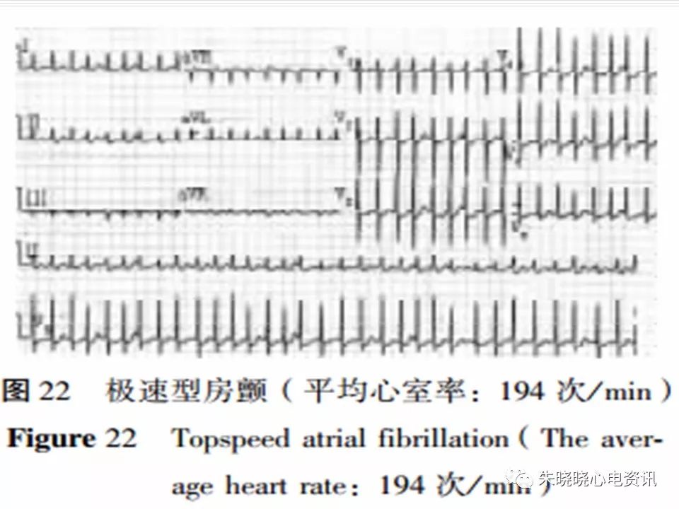 心电图危急值识别与诊断，看完我就收藏了！