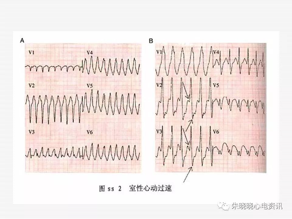 心电图危急值识别与诊断，看完我就收藏了！