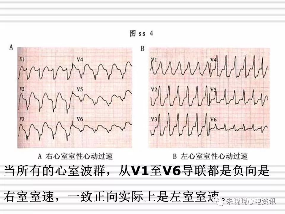 心电图危急值识别与诊断，看完我就收藏了！