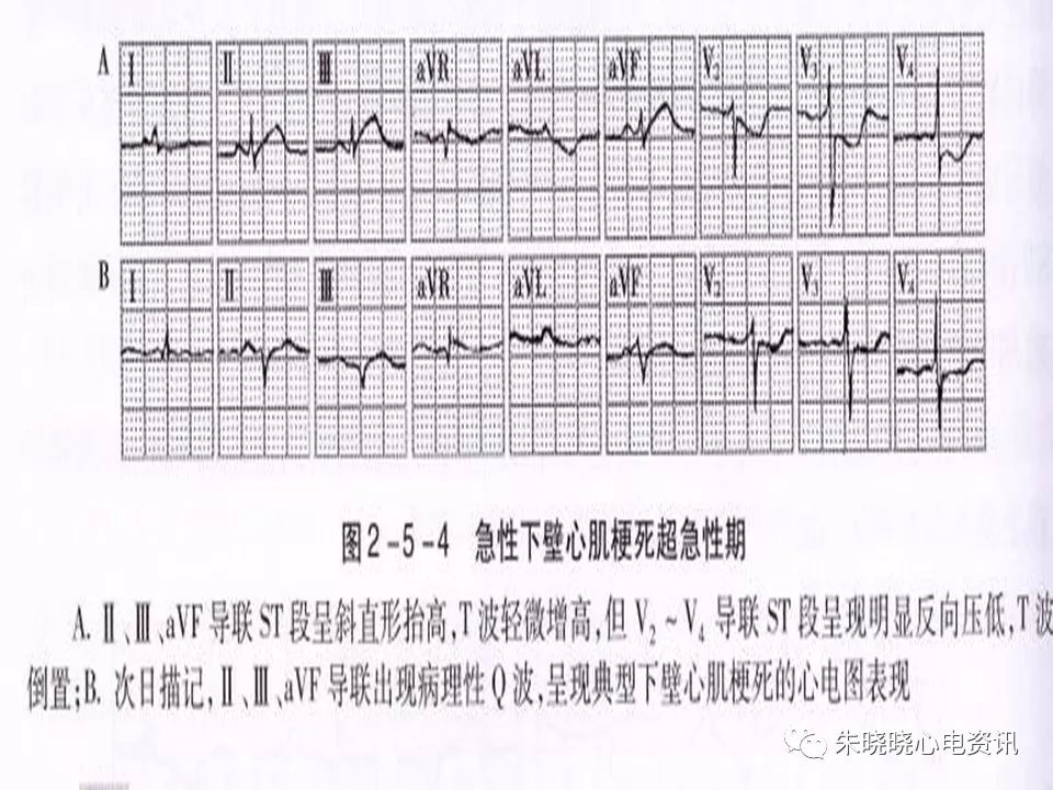 心电图危急值识别与诊断，看完我就收藏了！