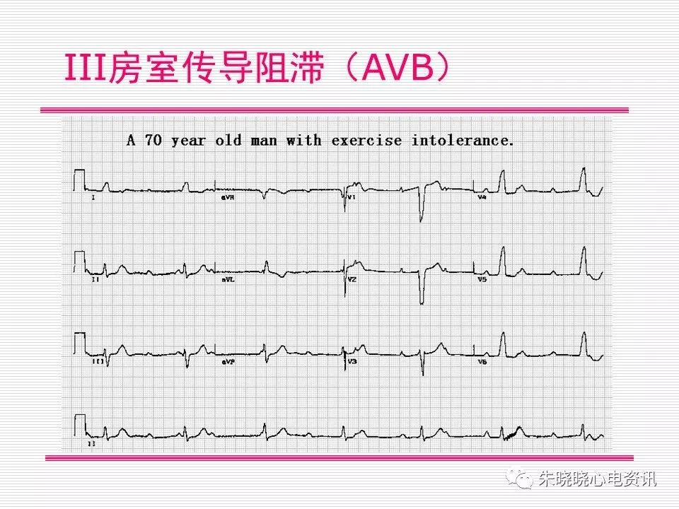心电图危急值识别与诊断，看完我就收藏了！