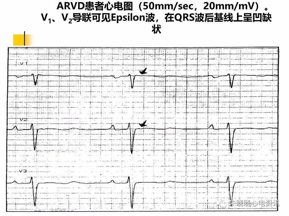 特殊心电图现象在急诊中的快速识别与处理，赶紧收藏！