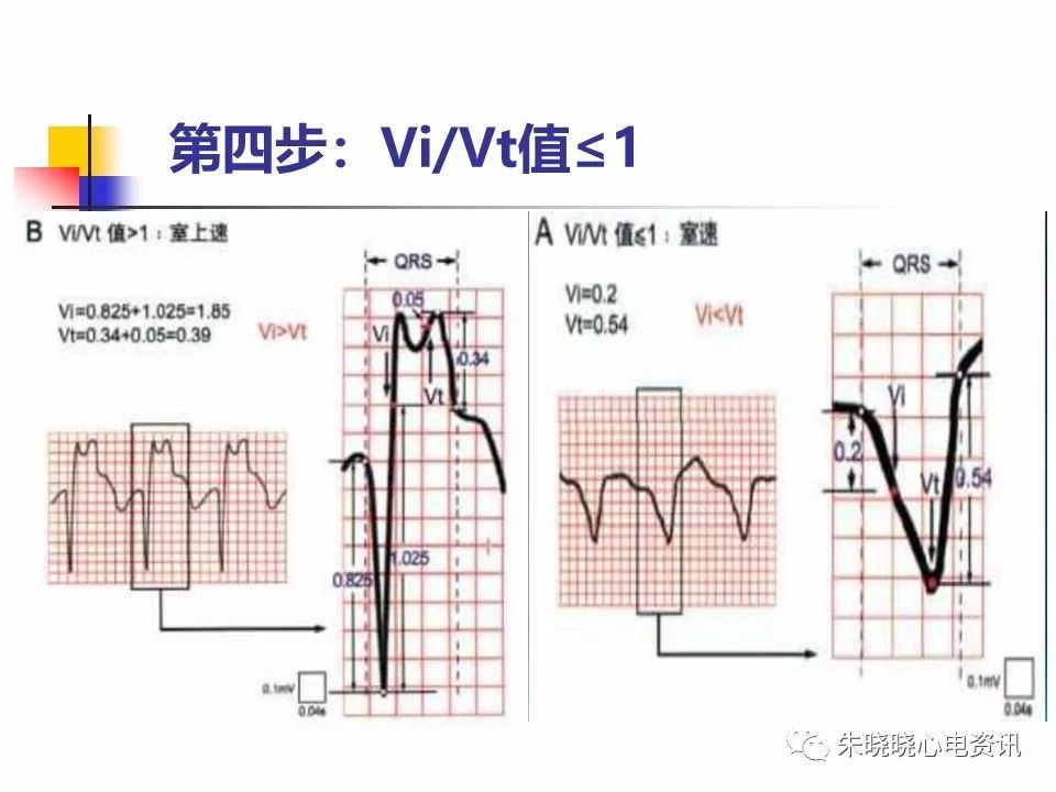 特殊心电图现象在急诊中的快速识别与处理，赶紧收藏！