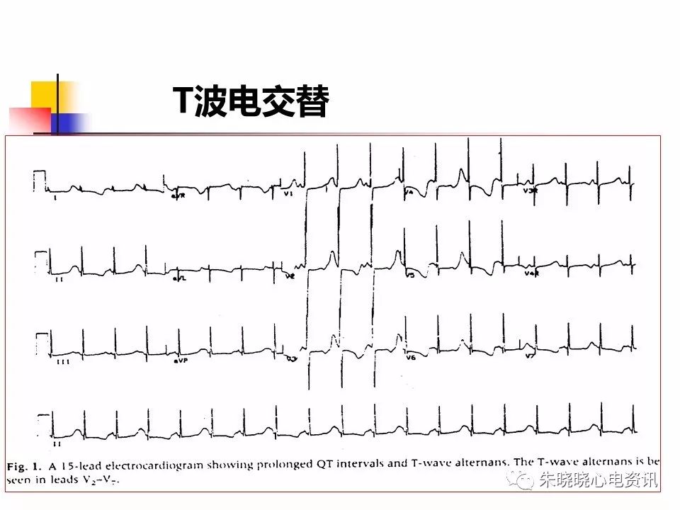 特殊心电图现象在急诊中的快速识别与处理，赶紧收藏！
