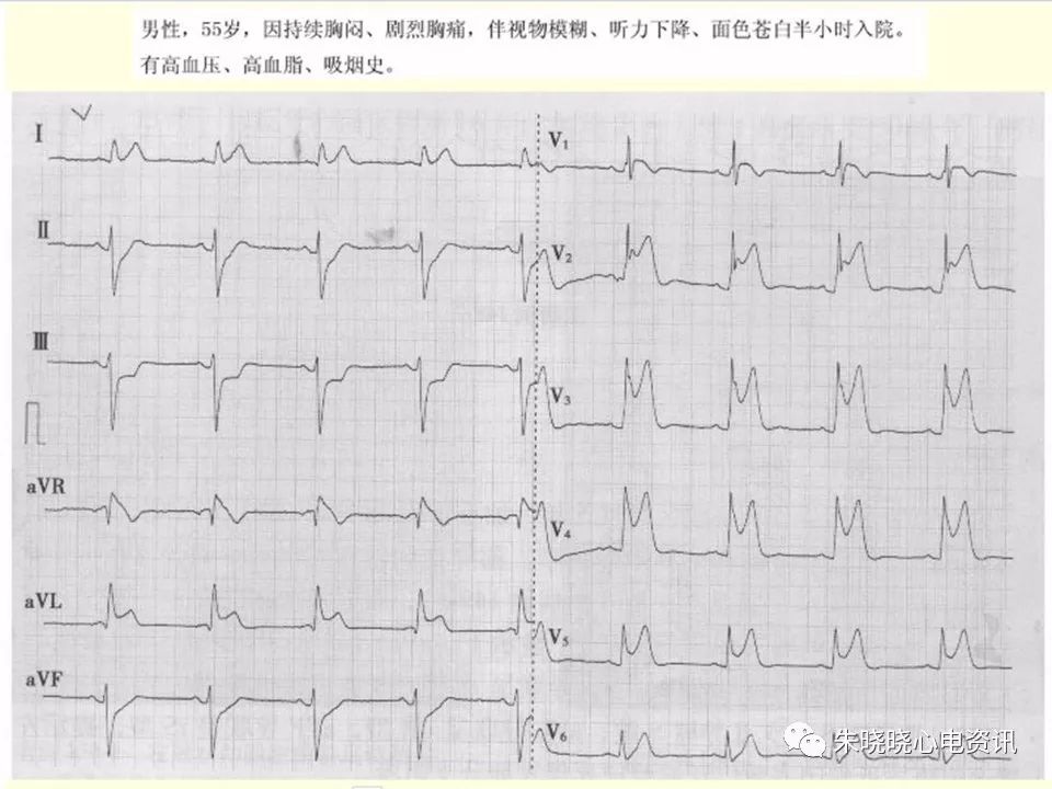特殊心电图现象在急诊中的快速识别与处理，赶紧收藏！