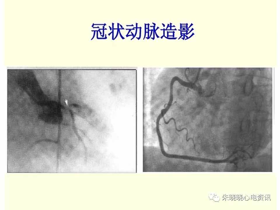 特殊心电图现象在急诊中的快速识别与处理，赶紧收藏！