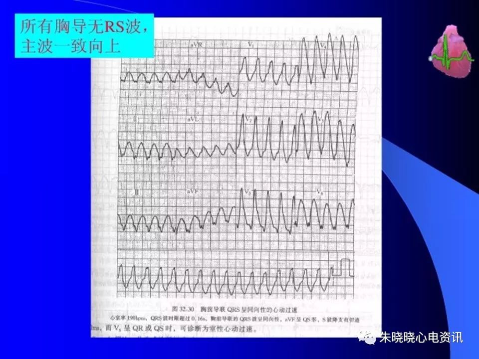 特殊心电图现象在急诊中的快速识别与处理，赶紧收藏！