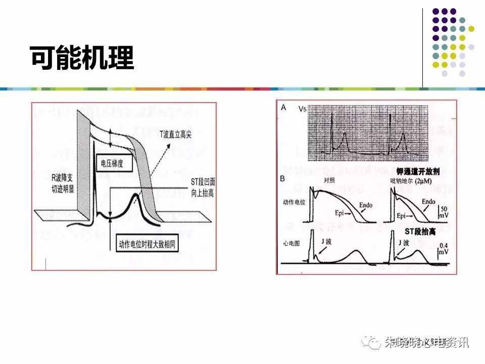 特殊心电图现象在急诊中的快速识别与处理，赶紧收藏！