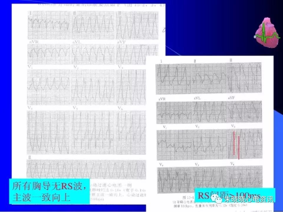 特殊心电图现象在急诊中的快速识别与处理，赶紧收藏！