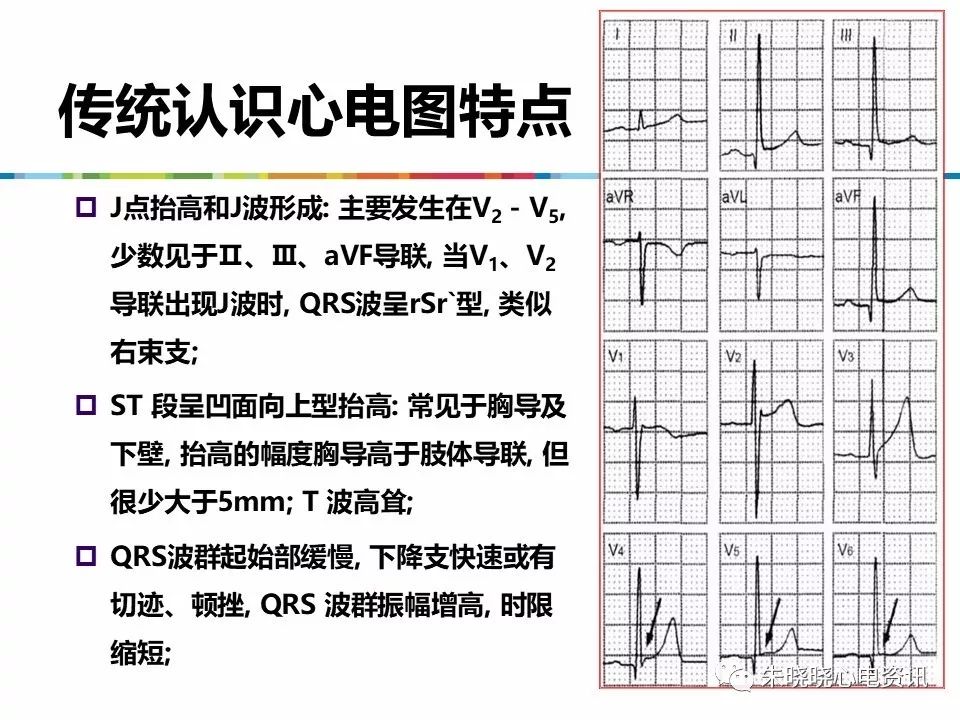 特殊心电图现象在急诊中的快速识别与处理，赶紧收藏！