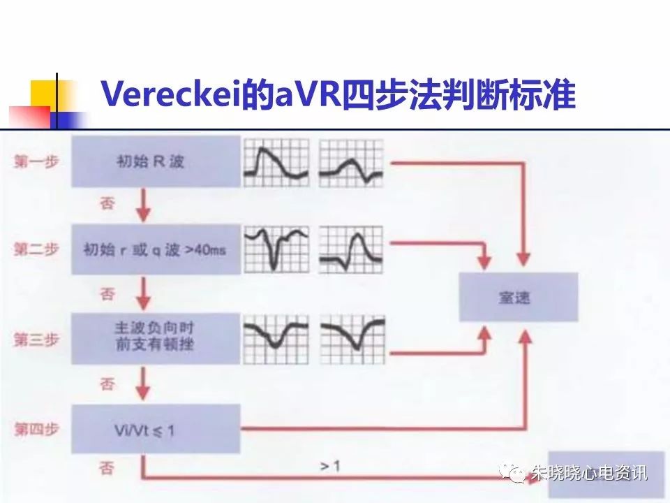 特殊心电图现象在急诊中的快速识别与处理，赶紧收藏！