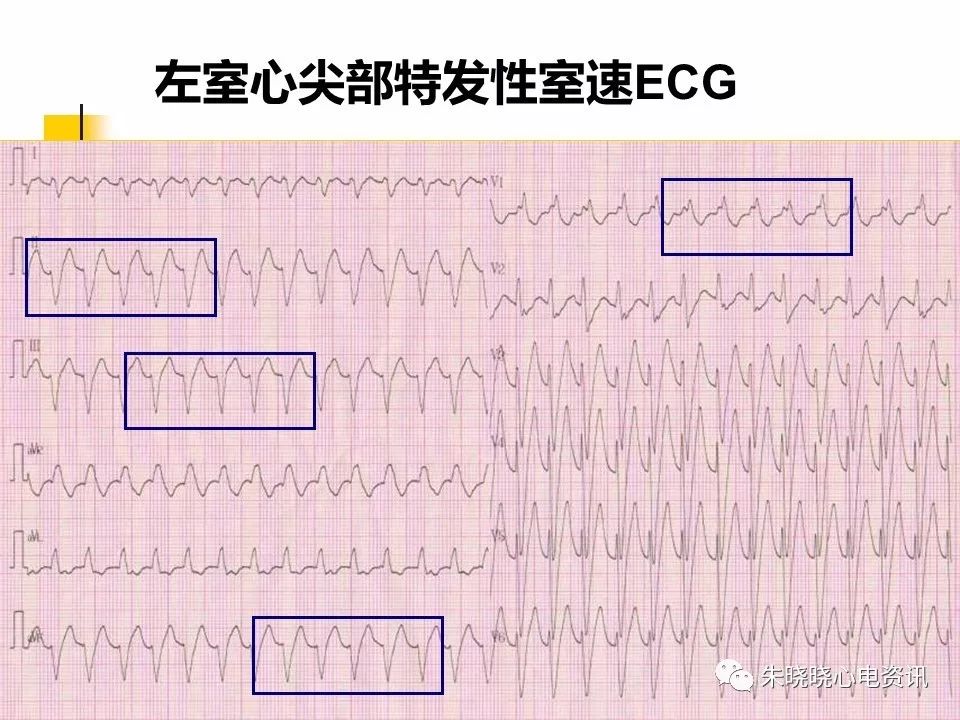 特殊心电图现象在急诊中的快速识别与处理，赶紧收藏！