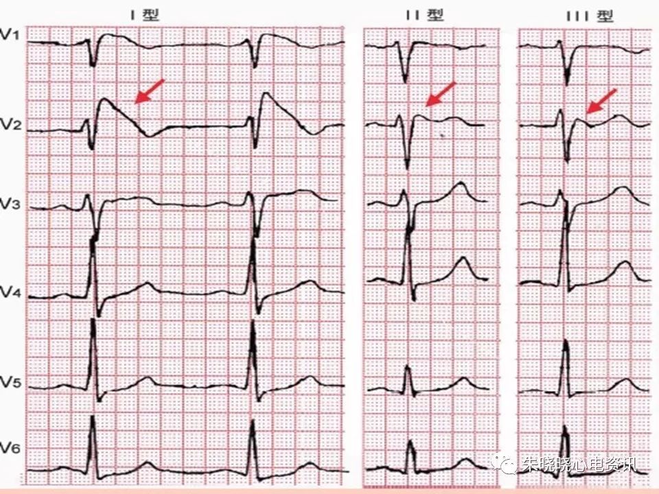 特殊心电图现象在急诊中的快速识别与处理，赶紧收藏！