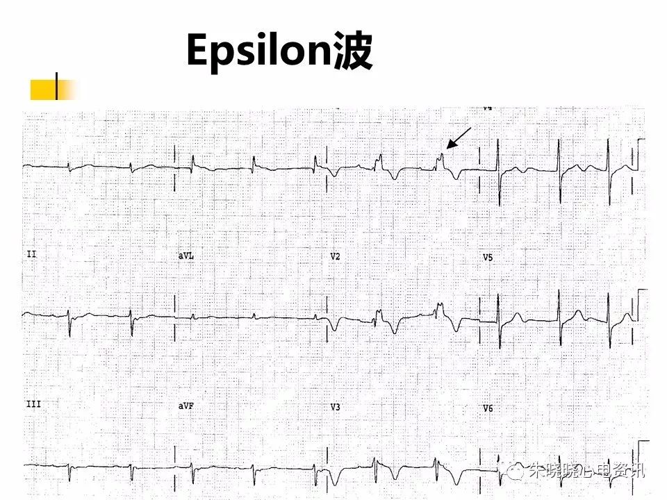 特殊心电图现象在急诊中的快速识别与处理，赶紧收藏！