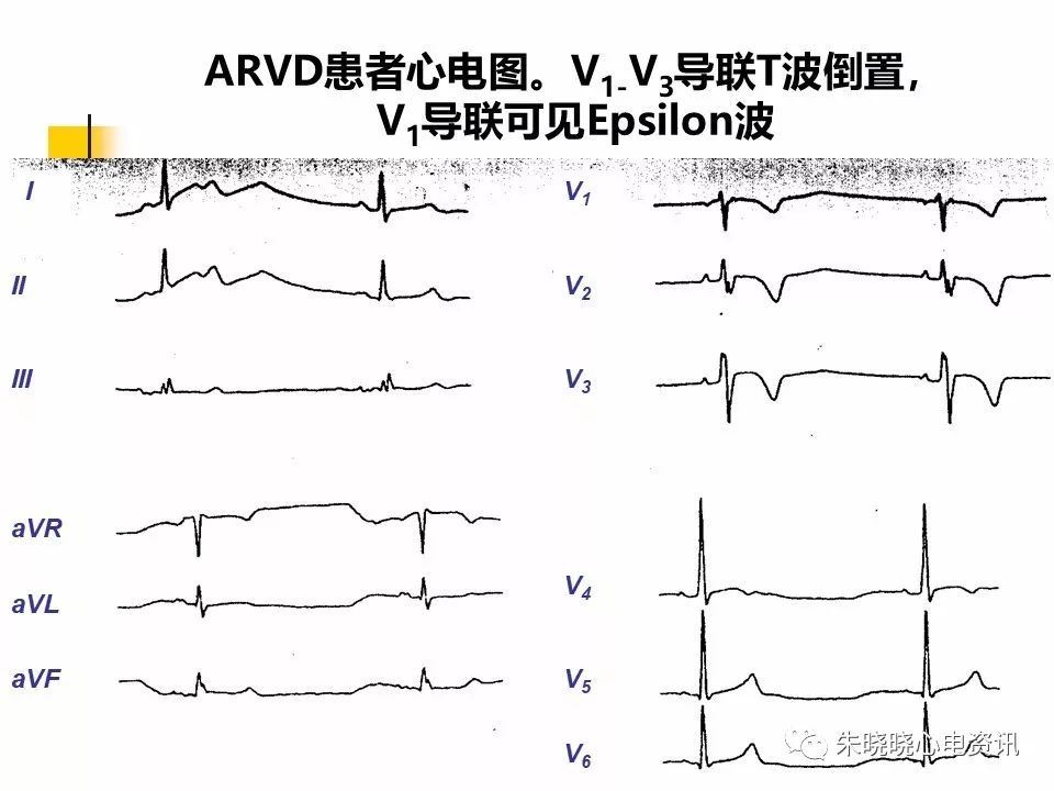 特殊心电图现象在急诊中的快速识别与处理，赶紧收藏！