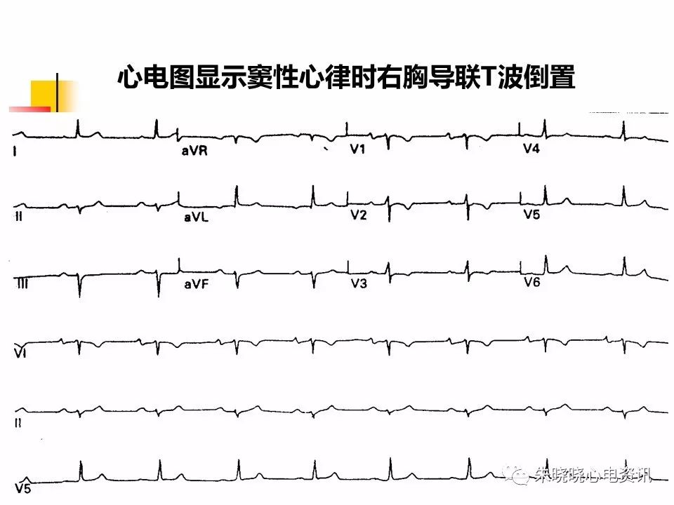 特殊心电图现象在急诊中的快速识别与处理，赶紧收藏！