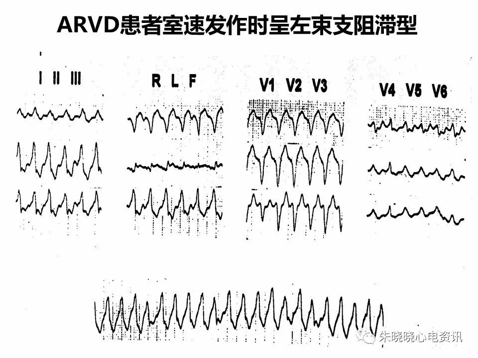 特殊心电图现象在急诊中的快速识别与处理，赶紧收藏！