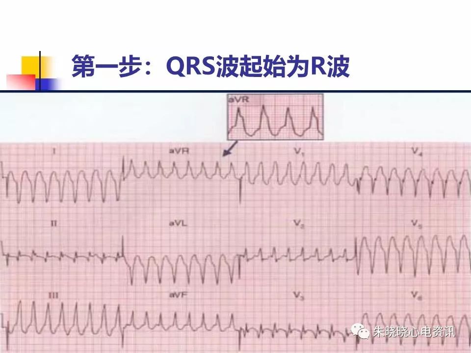 特殊心电图现象在急诊中的快速识别与处理，赶紧收藏！