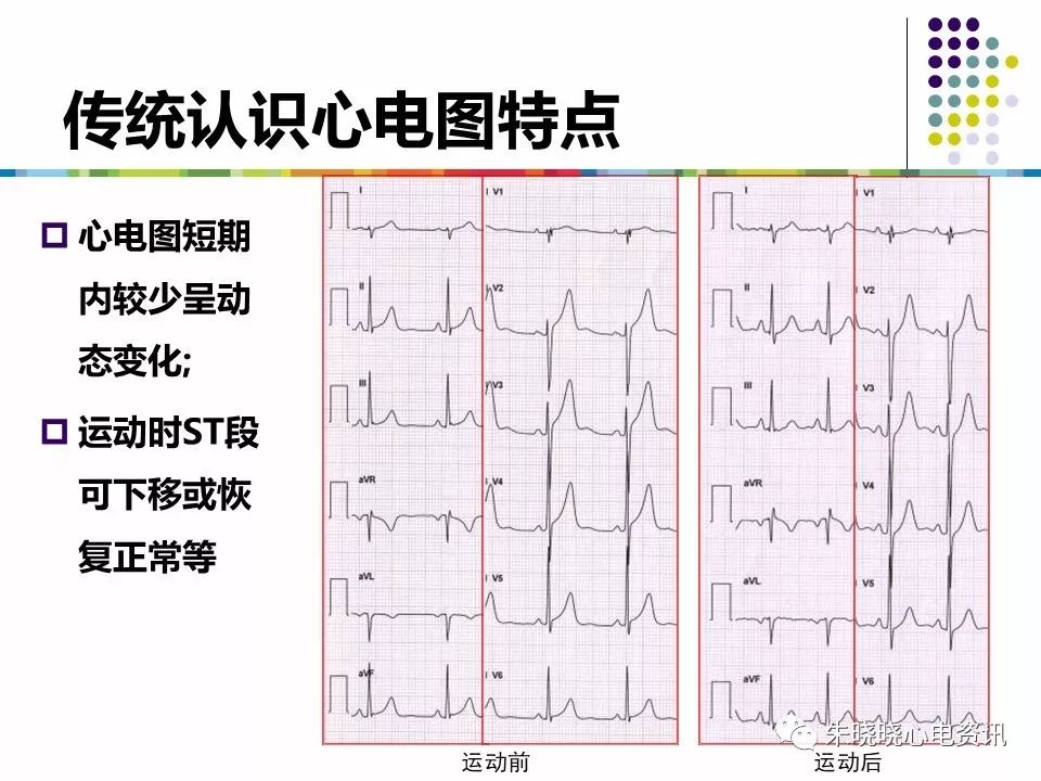 特殊心电图现象在急诊中的快速识别与处理，赶紧收藏！