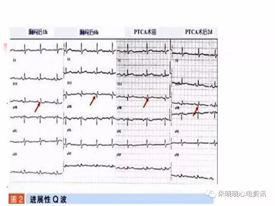 特殊心电图现象在急诊中的快速识别与处理，赶紧收藏！