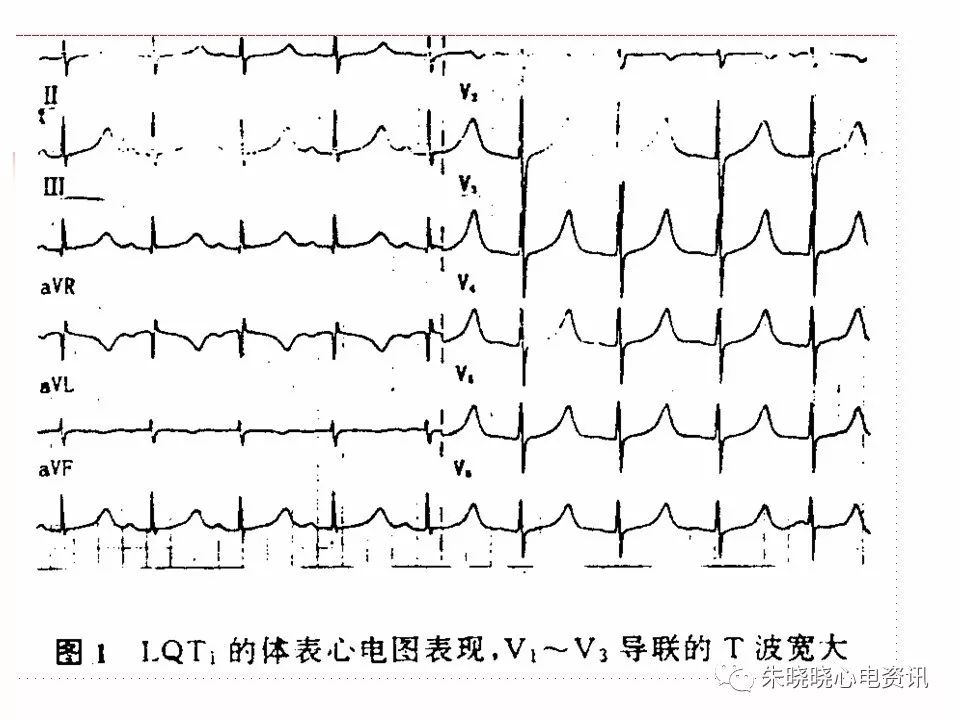 特殊心电图现象在急诊中的快速识别与处理，赶紧收藏！