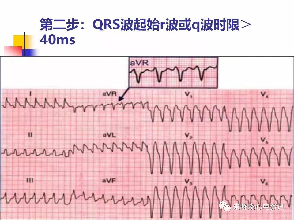 特殊心电图现象在急诊中的快速识别与处理，赶紧收藏！