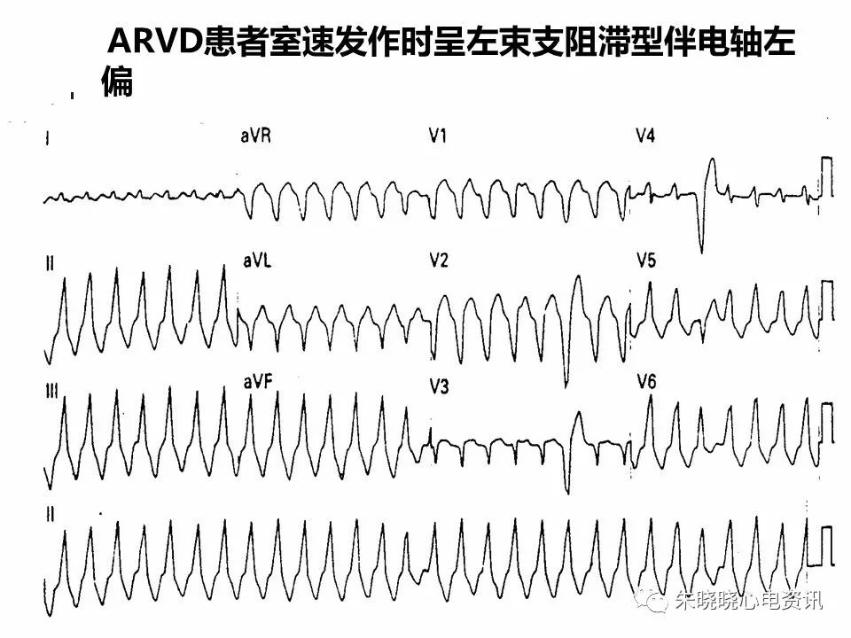 特殊心电图现象在急诊中的快速识别与处理，赶紧收藏！